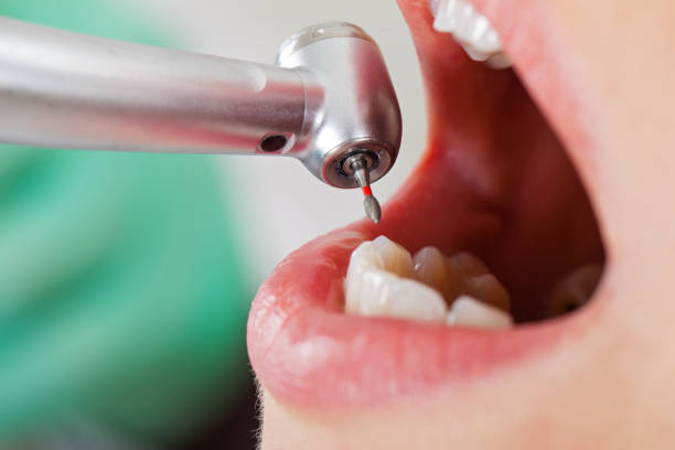 Best Emergency Wisdom Teeth Removal in Lonaconing, MD